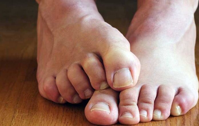 Συμπτώματα πλακώδους επιθηλίου στα πόδια