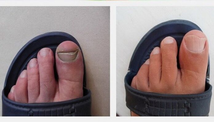 Τα νύχια των ποδιών πριν και μετά τη θεραπεία του μύκητα με μηλόξυδο